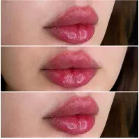 ژل و بوتاکس فیلرلب کانتورینگ مزوژل توسط پزشک۸۹۹