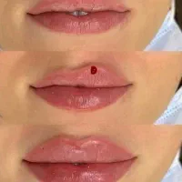 ۷۰ درصد آفر (ژل و بوتاکس و جوانسازی) انفجار زیبایی