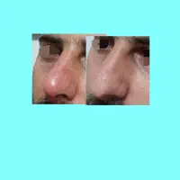 اصلاح فرم بینی بدون جراحی
