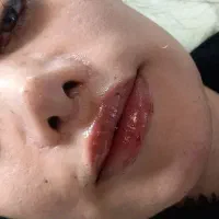 ژل وبوتاکس به روش ام.خال برداری.پیرسینگ.پاکسازی