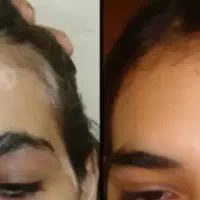 برای رفع بیماری پیسی اگزما با ما باش