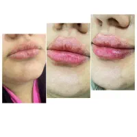 ژل‌فیلر‌بوتاکسPRP جوانسازوروشن کننده صورت و لیزر