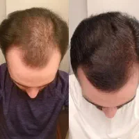با این محلول دیگه مشکل ریزش نداری