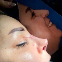 جراحی بینی/بدن/پروتز