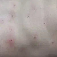 خال برداری با دستگاه پلاسما جت  ویژه بانوان