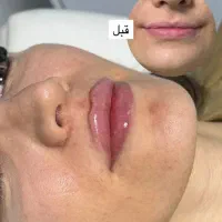 تزریق ژل و بوتاکس جشنواره تخفیف عیدانه ۳۹۹