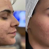 تخفیف فیشال خالبرداری روشنسازی وایتنینگ اموزش مدرک