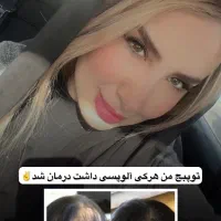 درمان قطعی وتضمینی ریزش سکه ای بدون بازگشت