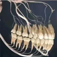 عصب کشی روکش کامپوزیت دندانپزشکی غرب تهران