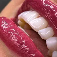 کامپوزیت  از  ۴م .لمینت دندان و دندانپزشکی.عصب کشی