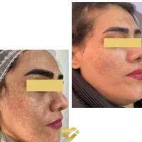 فیشیال پاکسازی پوست رفع جوش،لک،تیرگی،غبغب،چروک