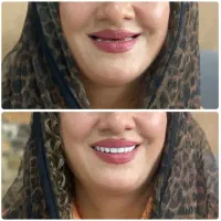 دندان مصنوعی تضمینی ، تحویل یک روزه