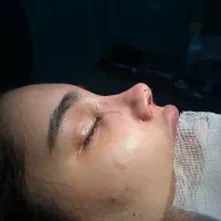 آف جراحی بینی  فقط ۴۳ اهواز