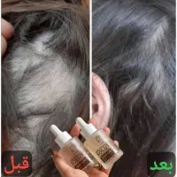تونیک ضد ریزش مو اکسونیک اصل (نتیجه در یک ماه)