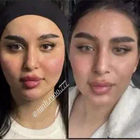 ژل و بوتاکس انزیم و مزو