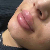 تزریق ژل وبوتاکس