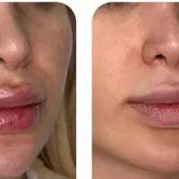 تزریق بوتاکس،فیلر ،ژل لب،مزوتراپی توسط پزشک مجرب