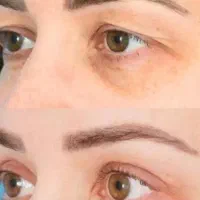 بلفاروپلاستی بدون رد بخیه