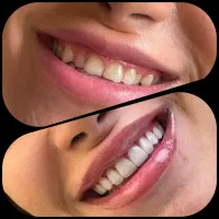 خدمات تخصصی کامپوزیت ونیر با کیفیت با شرایط اقساط