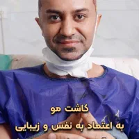 کاشت مو، کاشت ابرو، کاشت شقیقه و کاشت ریش