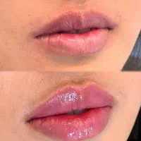 ژل وبوتاکس