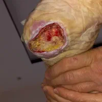 درمان انواع زخم