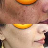معجزه پوست با آف ویژه