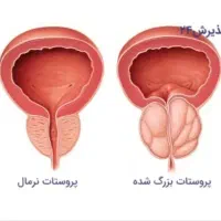 دیابت و پروستات،در*ما*ن قطعی