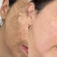 فیشیال و پاکسازی تخصصی پوست تخفیف ۵۰ درصد مفتح