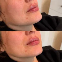 اسپارتینا لاغری بوتاکس ژل فیلر مزوژل نخ لیف