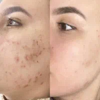 پک های درمانی با نصف قیمت فقط امروز