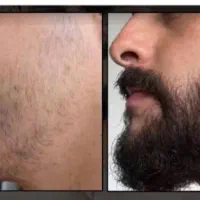 سرم برای پرپشتی ریش وسبیل