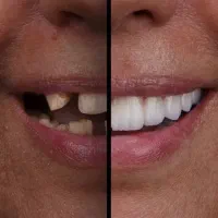 ایمپلنت کره‌ای درجه یک فقط 15/800 + اقساط یک ساله