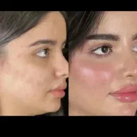 آف 50 درصدی ژل و بوتاکس