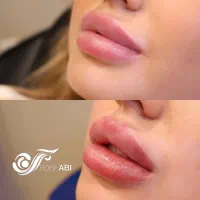 جشنواره بهاره ژل و بوتاکس