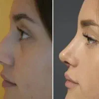 جراحی بینی/لیپو/ابدو/مامو