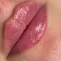 تزریق ژل و بوتاکس. پی آرپی