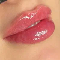 تخفیف ۵۰درصدی محرم صفر ژل اصلی نورامیس ۱۶۰۰ بوتاکس