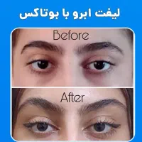 بوتاکس توسط پزشک با تخفیف باورنکردنی