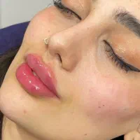 جشنواره تخفیفات ویژه ژل وبوتاکس