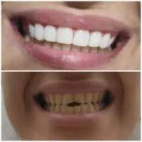 تخفیف بهاره کامپوزیت فکی 13م ،عصب کشی پرکردن 3500