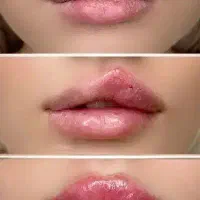 ژل و بوتاکس همراه آموزش