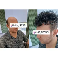 بازگشت جوانی پروتز پشت کردن مو