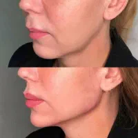 تزریق فیلر با قیمت عالی 380