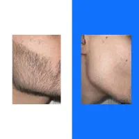 افزایش تراکم ریش
