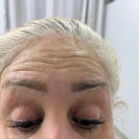 تخفیف ویژه تزریق ژل۷۹۰و بوتاکس۵۹۰مزوژل۸۹۰توسط پزشک