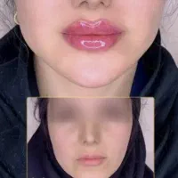 آف خدمات مطب ژل و بوتاکس پک های مادلینگ