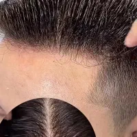 مرکز پروتزمو و ترمیم مو بدون پیش پرداخت(اقساطی)
