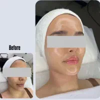 فیشیال،رفع غبغب،رفع تیرگی بدن،رفع لک،برداشتن خال