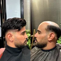 پروتز مو  فرتاس